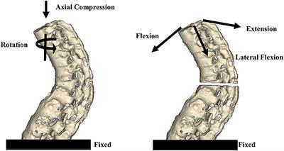 Biomechanical Evaluation of the Transcortical and Transpedicular Trajectories for Pedicle Screw Insertion in Thoracolumbar Fracture Fixation for Ankylosing Spondylitis